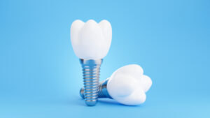 Rossmoor dentist dental implants in Walnut Creek